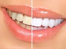 gallery/teeth-whitening